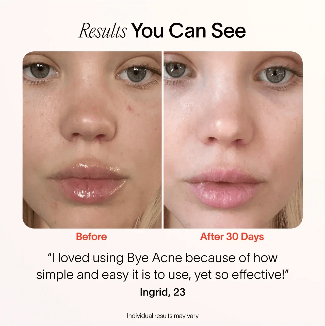 Bye Acne: 3-Minute Pimple Spot Treatment - My Store 3