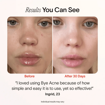 Bye Acne: 3-Minute Pimple Spot Treatment - My Store 3