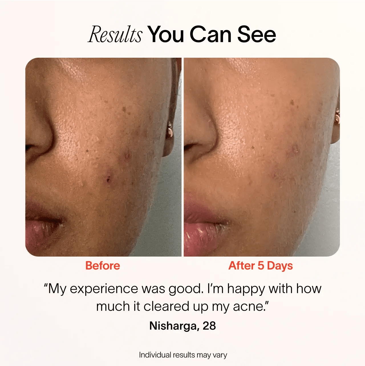 Bye Acne: 3-Minute Pimple Spot Treatment - My Store 3
