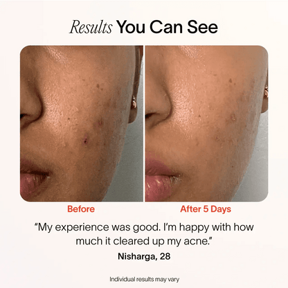Bye Acne: 3-Minute Pimple Spot Treatment - My Store 3
